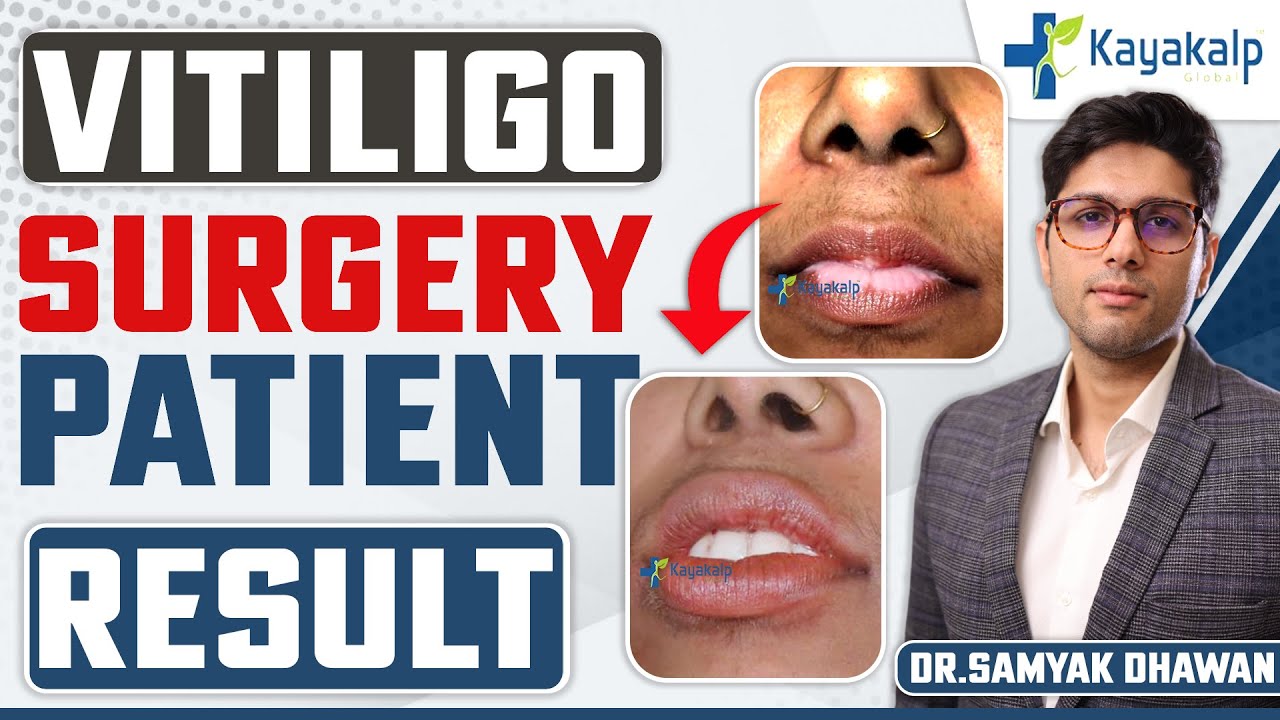 सफ़ेद दाग का इलाज Surgery से? | Vitiligo Surgery | Vitiligo Treatment by Micropigmentation