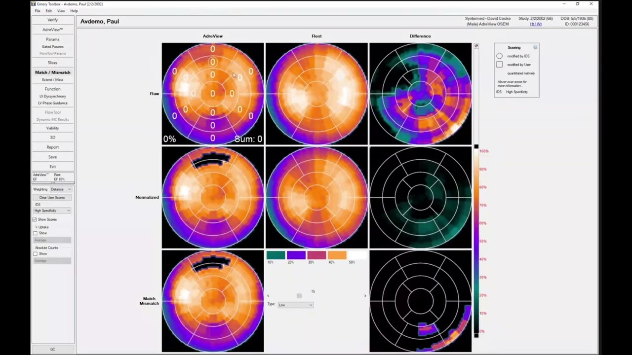 ECTb SPECT Adreview