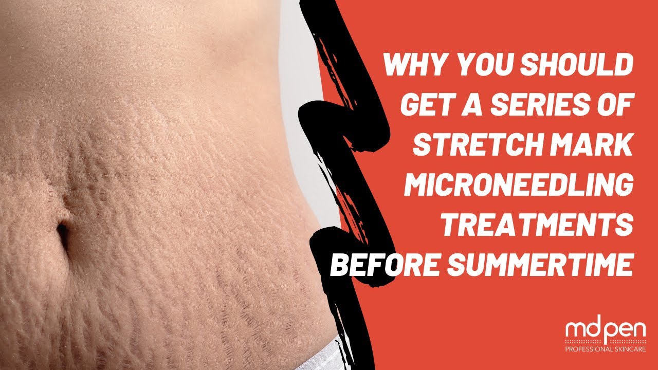 Stretch Mark Microneedling Treatment Deadline!