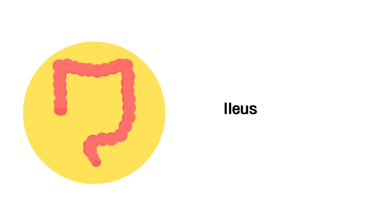 Darmverschluss (Ileus) - Erkrankungen des Verdauungssystems