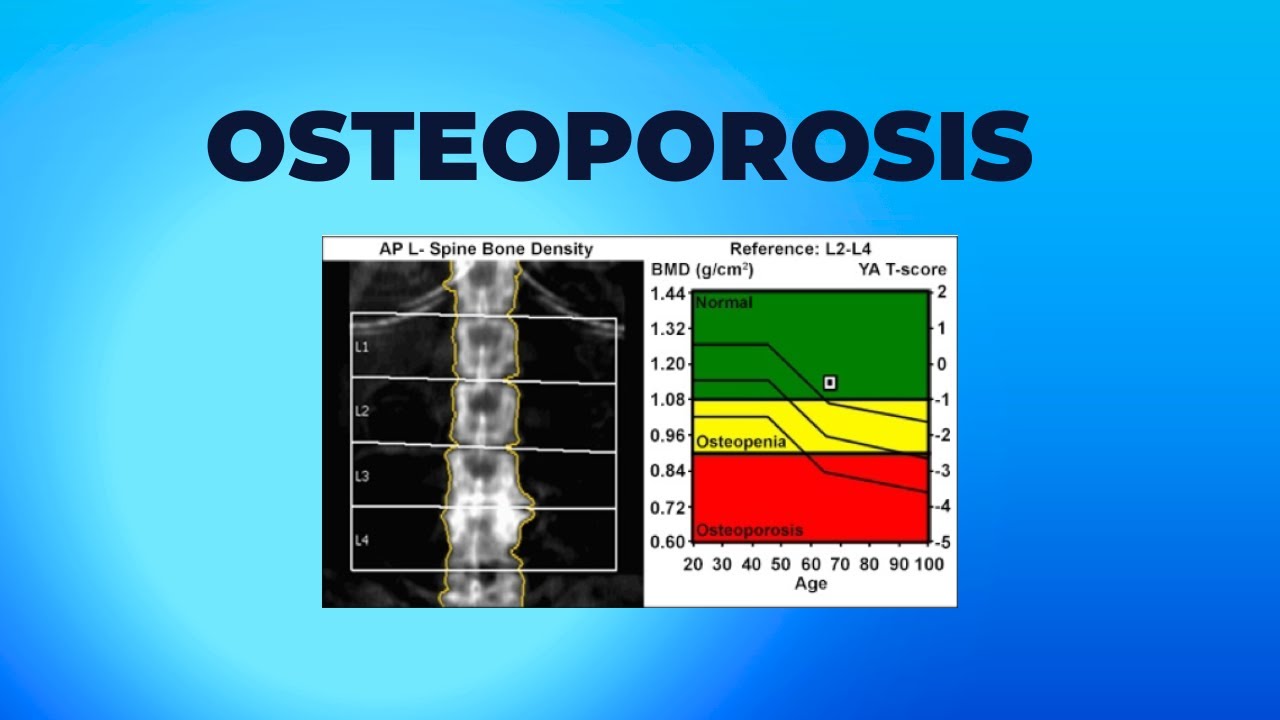 Osteoporosis