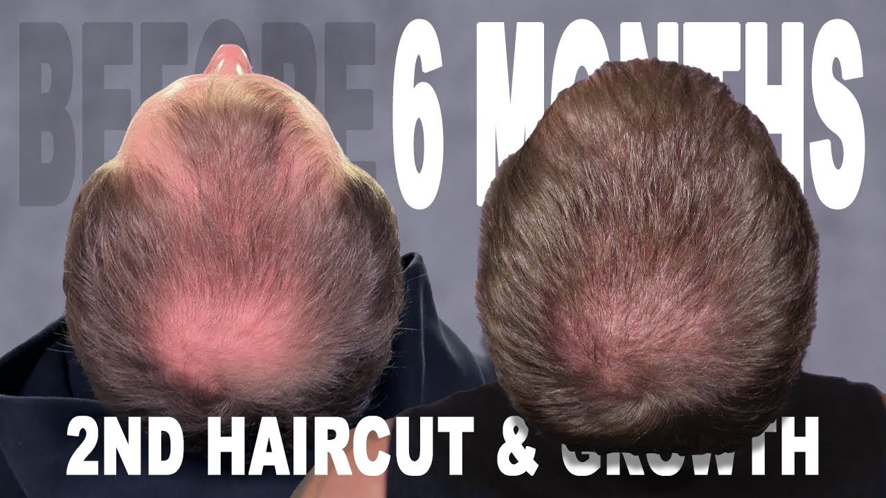 6 MONTHS | HAIR TRANSPLANT | COSMEDICA CLINIC