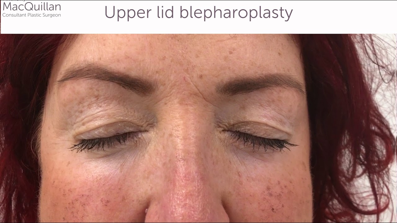 Upper lid blepharoplasty before and after