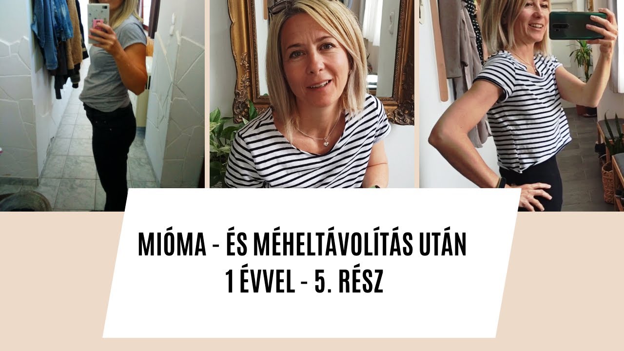 Mióma - és méheltávolítás után 1 évvel | 5. rész | Schindler Ildi