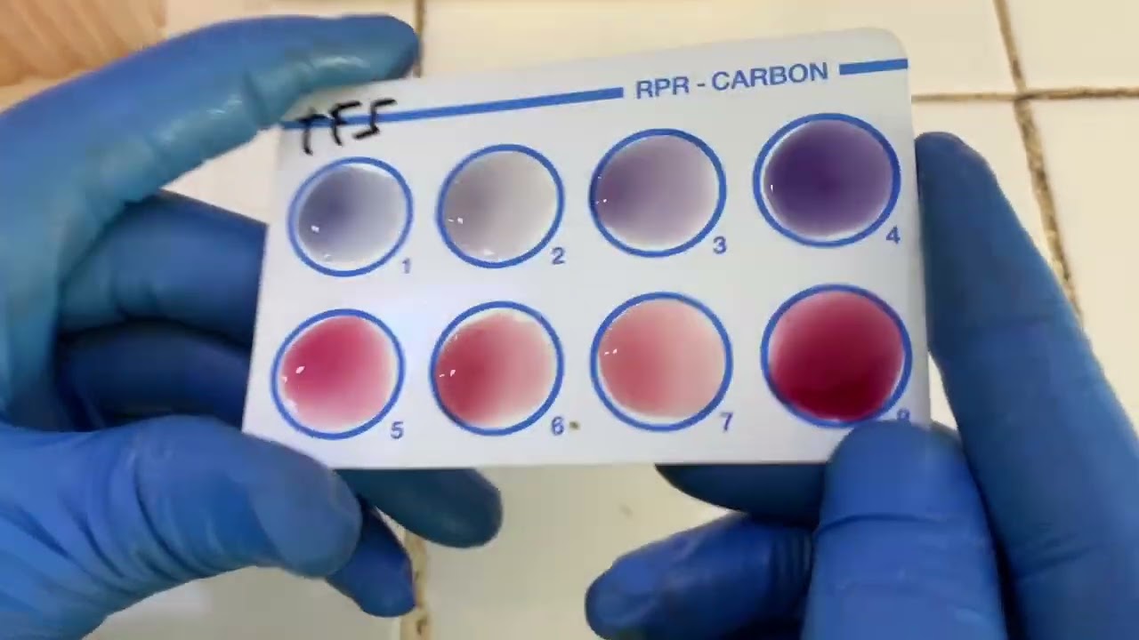 Sérodiagnostic de widal et Félix ( fièvre typhoïde et paratyphoïde) #foryou #analyse #biology