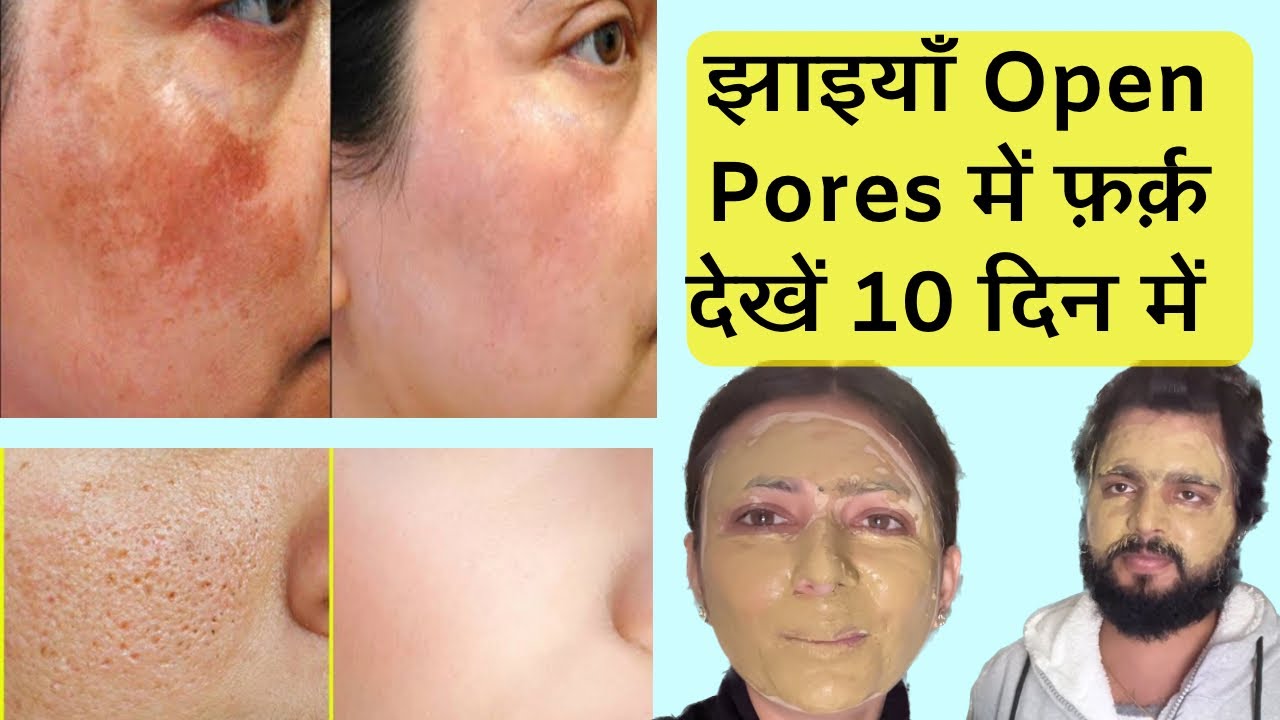 पुरानी से पुरानी झाइयों को ठीक करें | Open Pores Pigmentation Jhaiya Remedy | Dr. Upasana Vohra