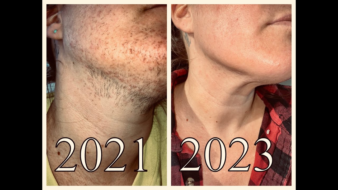 144 Hours of Electrolysis Hair Removal | Before and After Pics & Footage | PCOS / Hirsutism Support