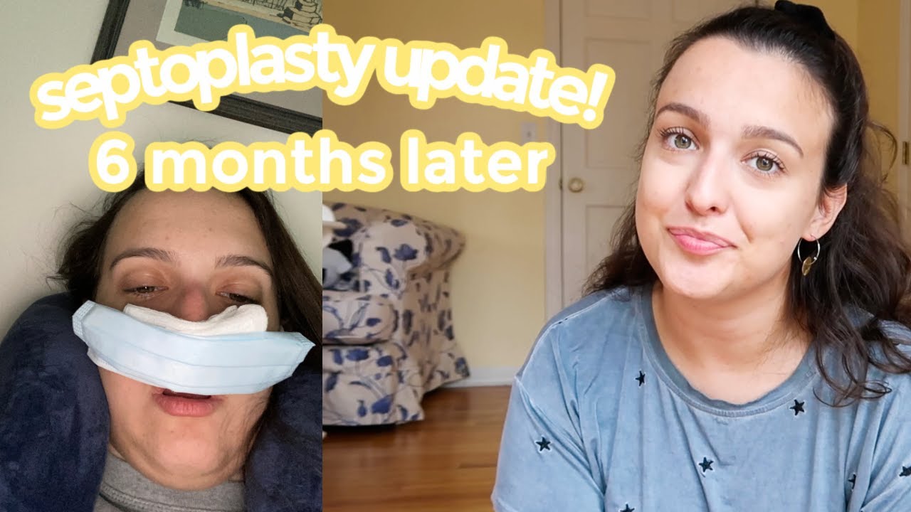 my SEPTOPLASTY update: 6 months later!! was it worth it?! my full recovery & thoughts!