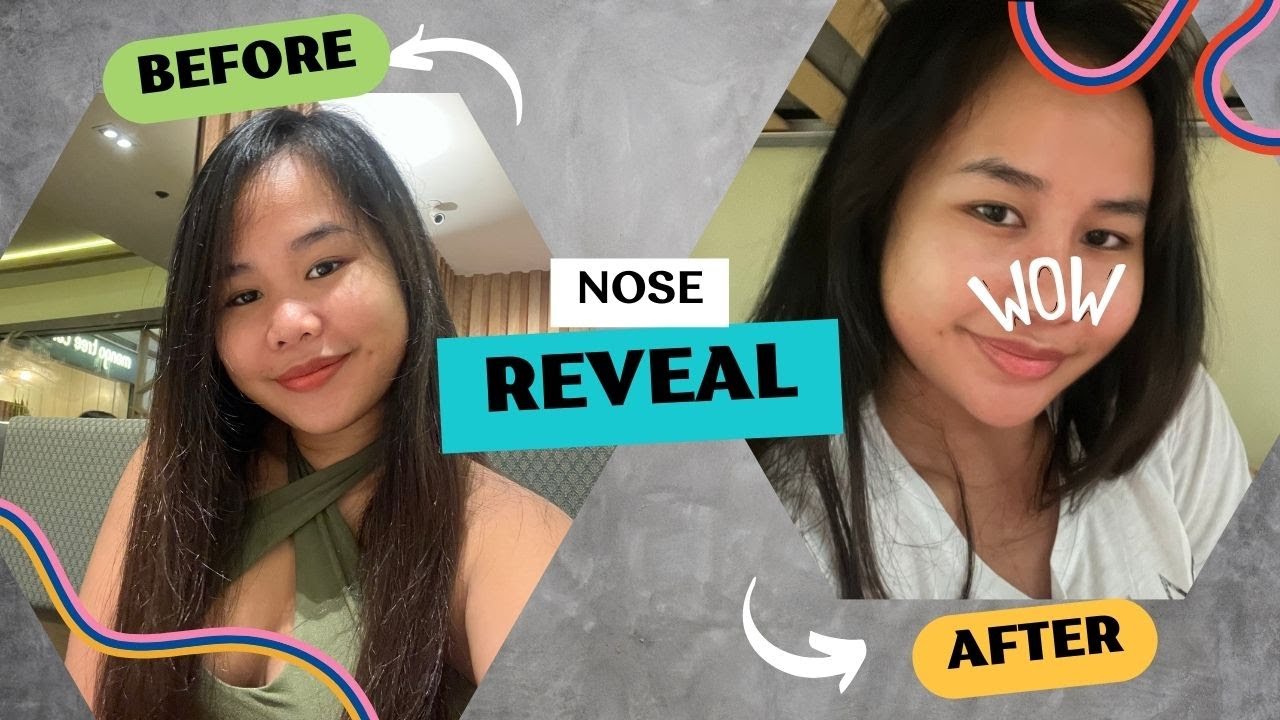 My Rhinoplasty Journey EP2: (post-op care, how much, NOSE REVEAL) Elyse Aesthetics |Milleyjn Aira