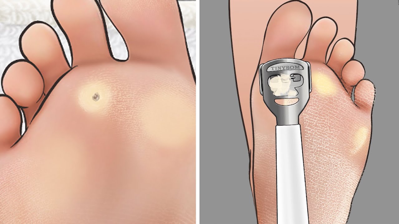 [ASMR] 대리만족 ! 발 각질, 티눈 케어 애니메이션  / Feet exfoliation, corn removal animation