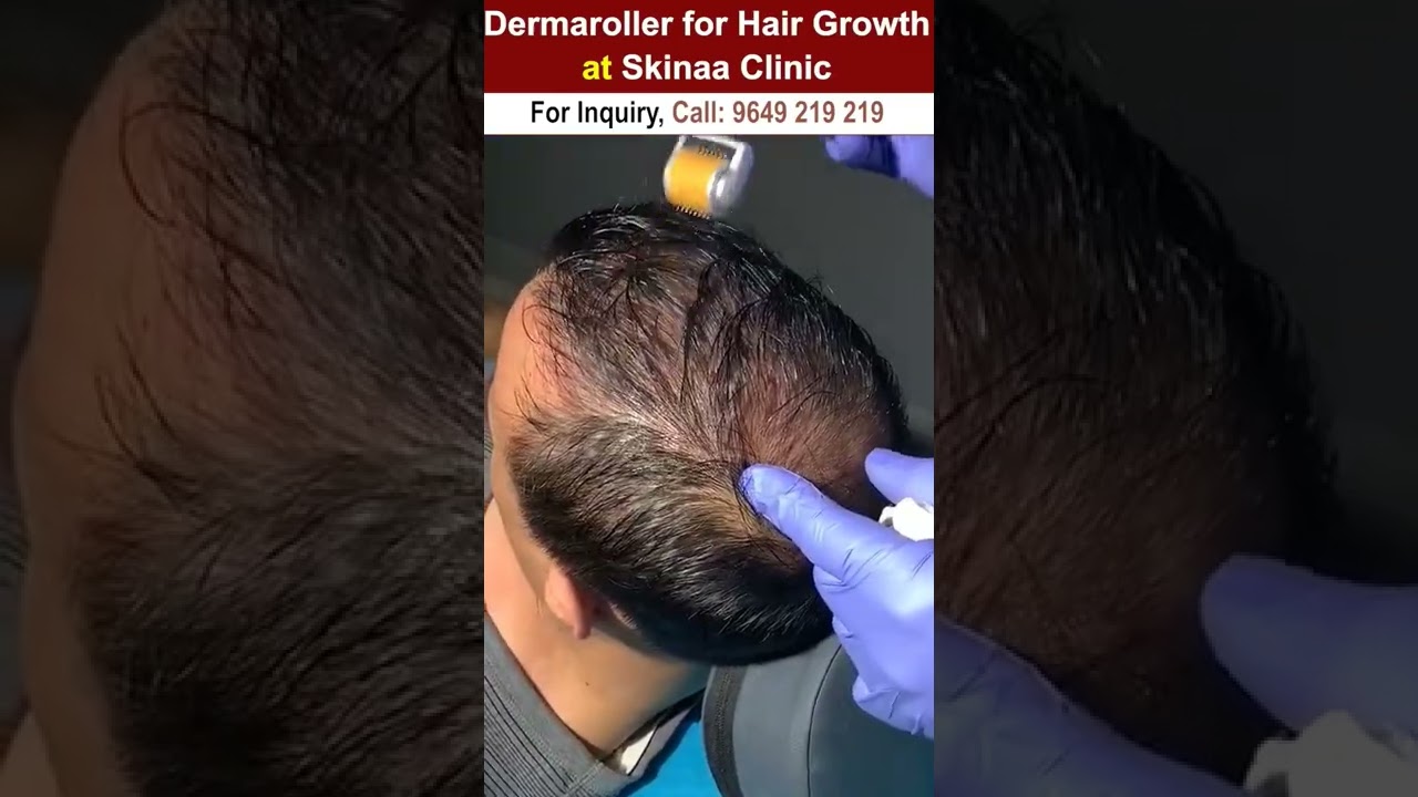Dermaroller for hair growth #dermaroller #dermarollerforhairgrowth #hairgrowth #dermarollerforhair
