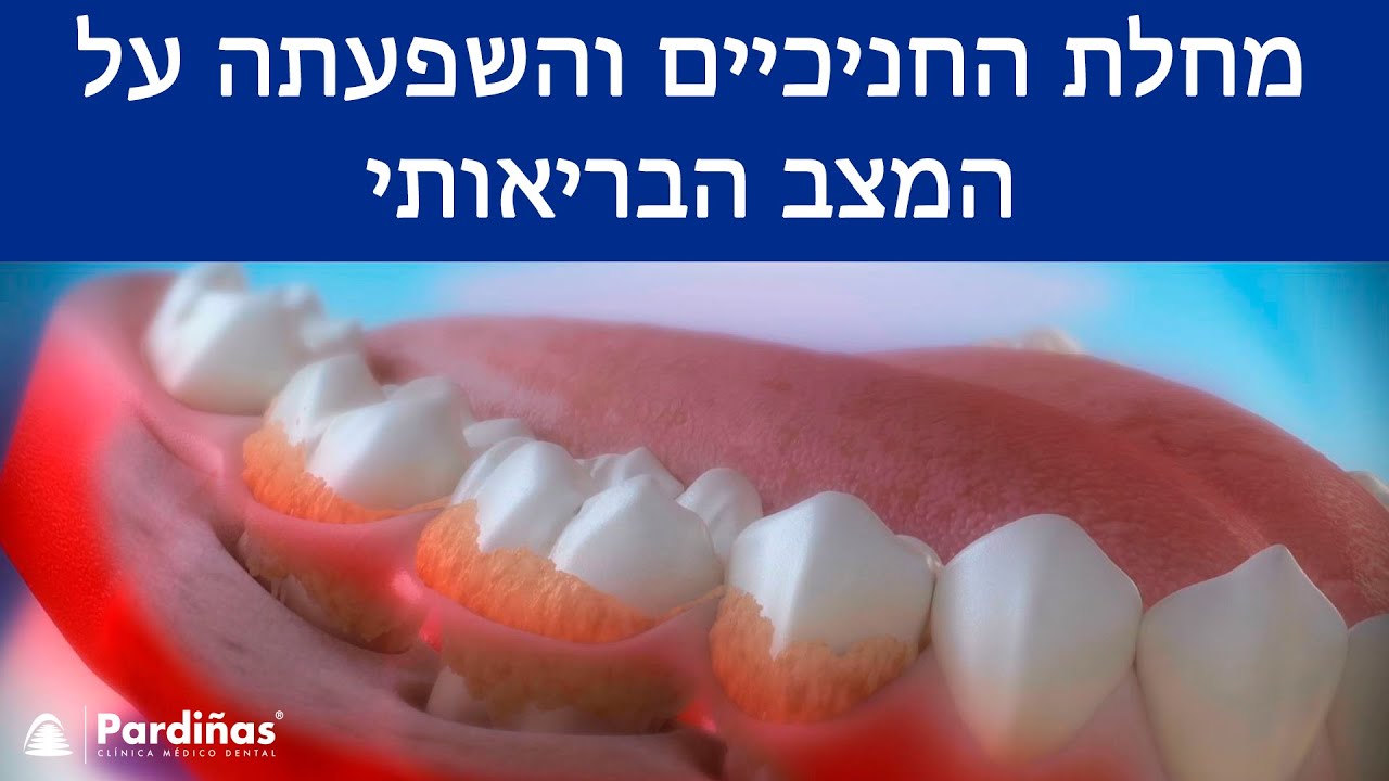 מחלת החניכיים והשפעתה על המצב הבריאותי ©