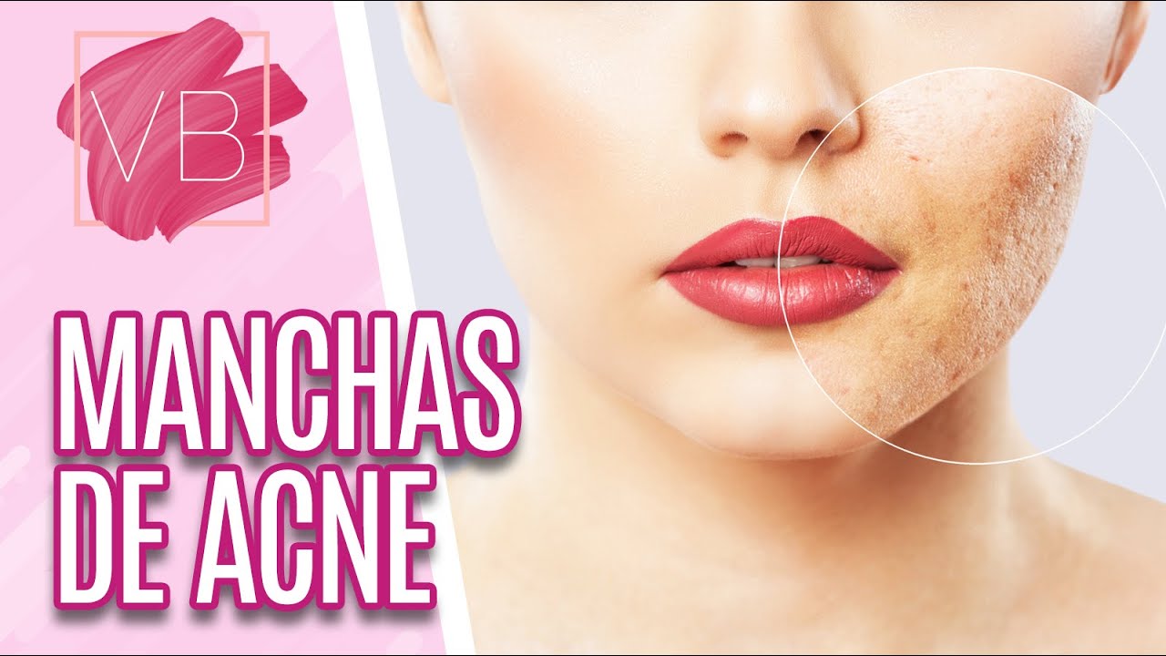 Como tratar manchas de acne - Voc&ecirc; Bonita (15/09/20)