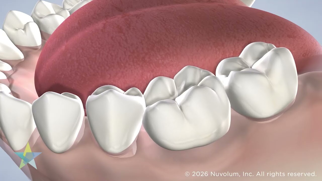 Tooth Replacement Options in Dallas, TX