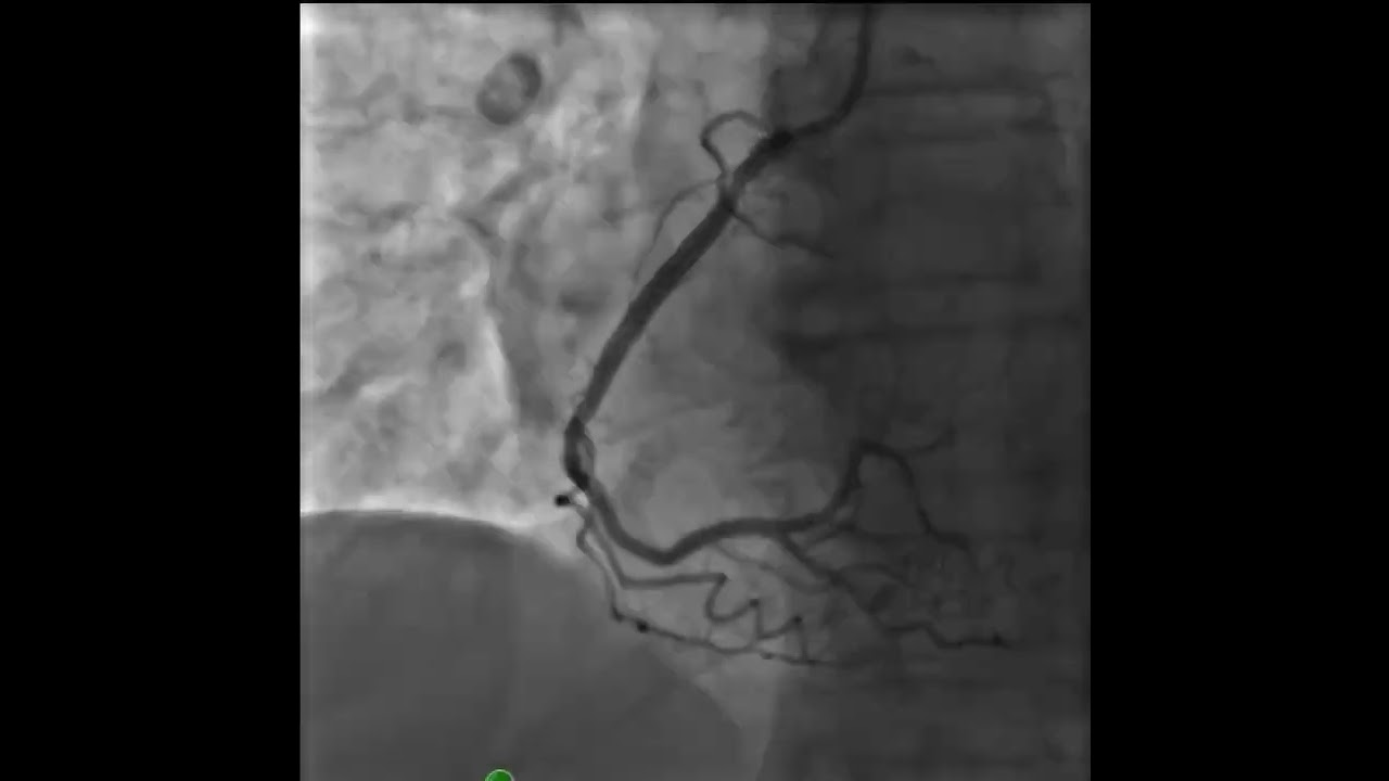 Severe Ostial RCA Stenosis is Visualized in this Angiogram