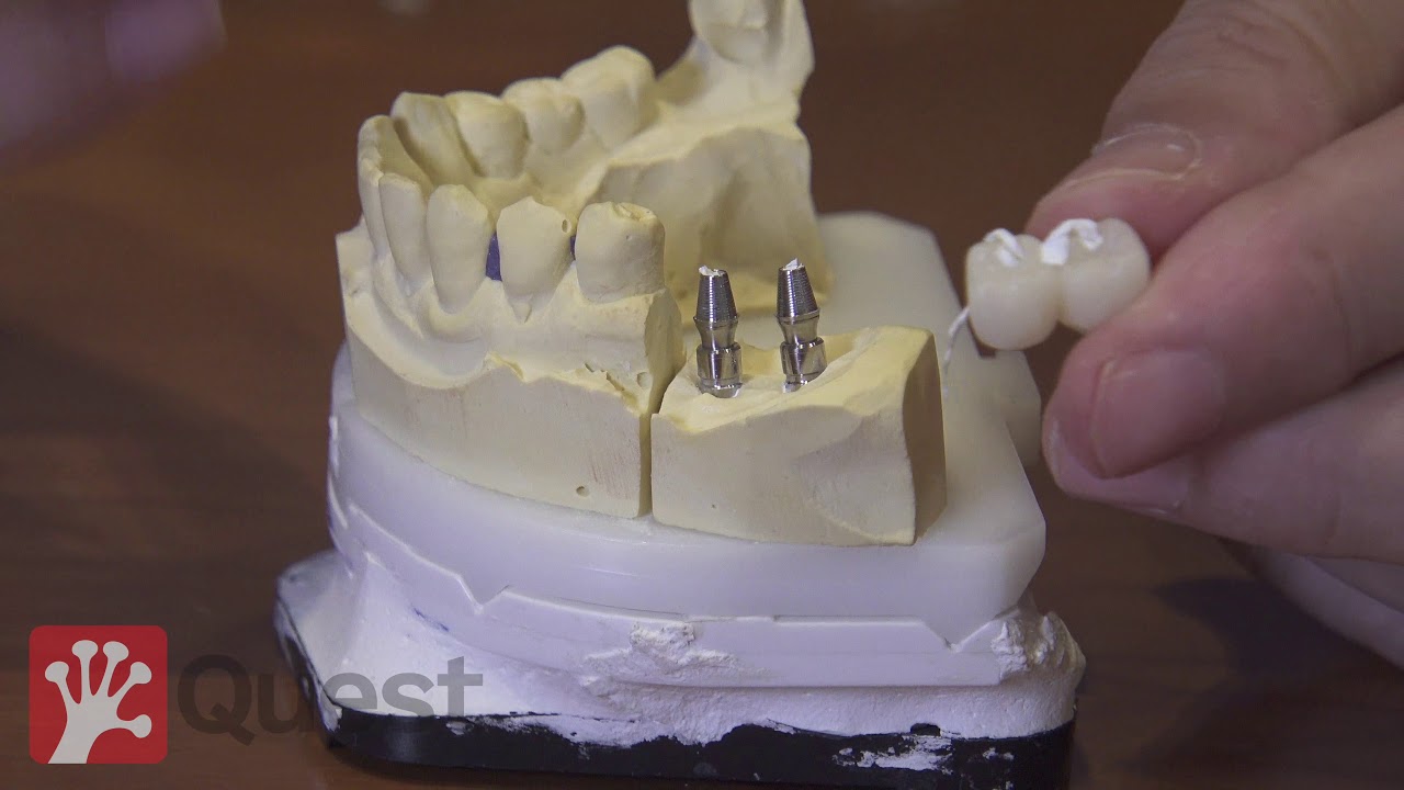 Sistema dual de prótesis fija sobre implantes con clip sobre pilar intermedio (Fixpeek®)