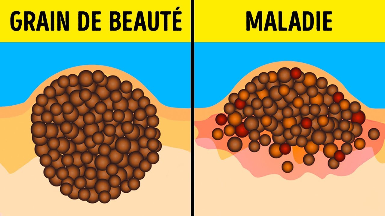 9 Mythes Dangereux Sur Les Grains de Beauté et le Bronzage