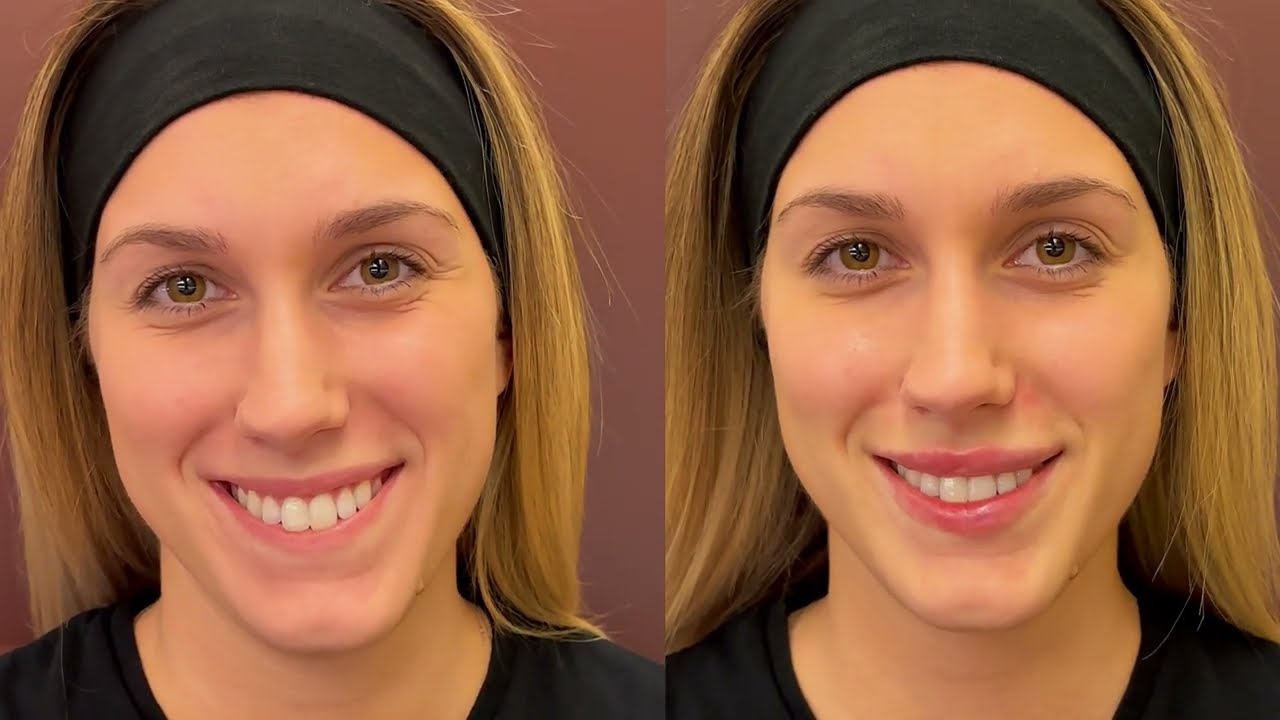 Filler Acido Ialuronico: Il Segreto per un Viso Giovane e Armonioso! Scopri Tutto sul Trattamento