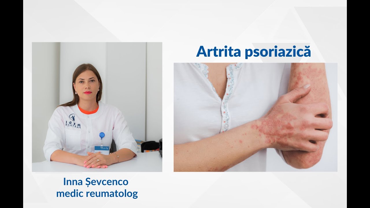 Artrita psoriazică, Inna Șevcenco, medic reumatolog