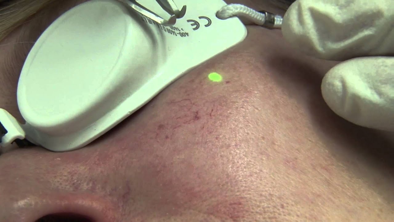 Couperose - Gef&auml;&szlig;e: Ver&ouml;dung mit dem Laser