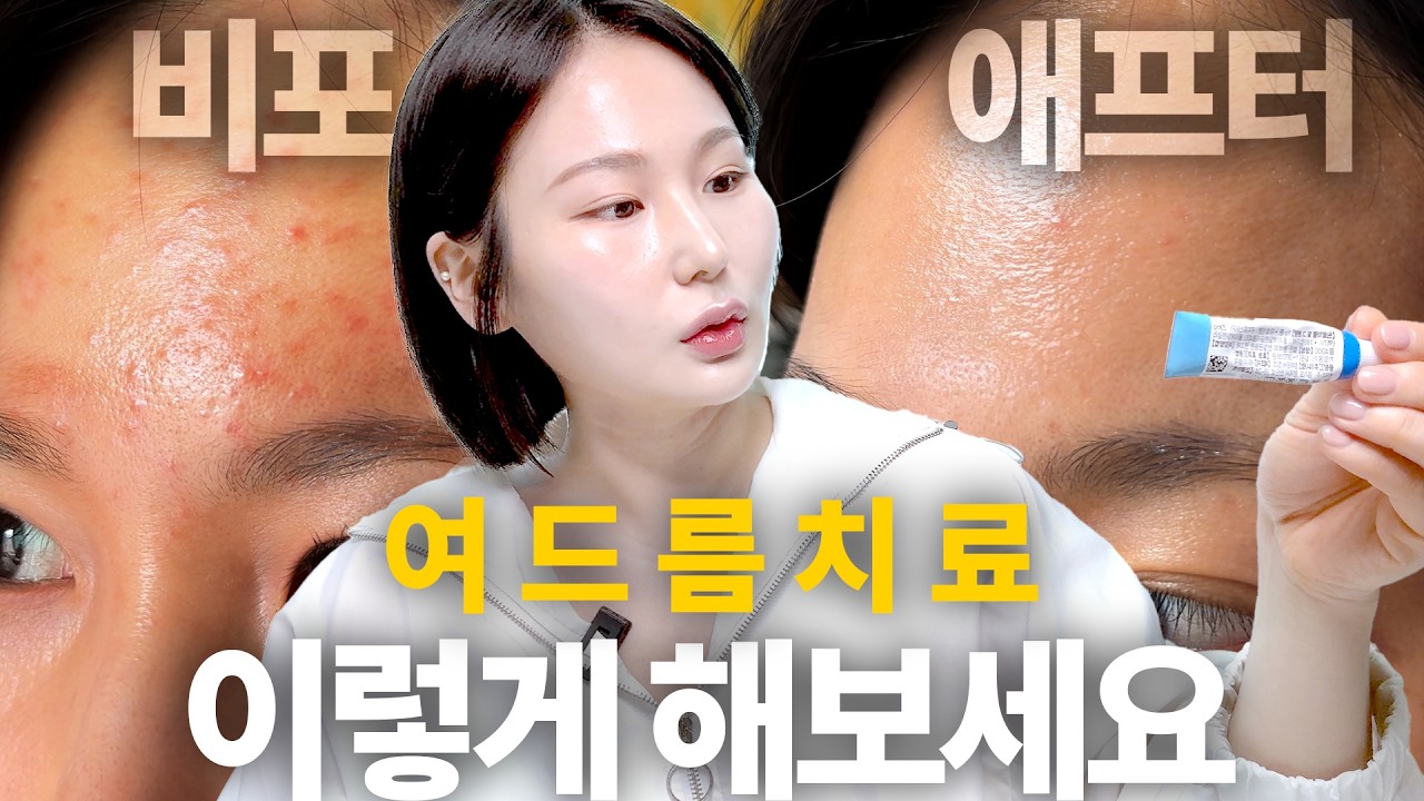 여드름? 모낭염? 이렇게 해보세요