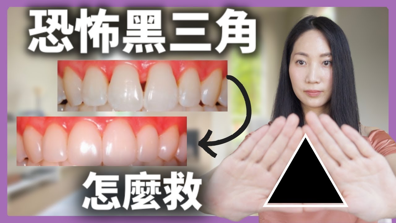 (ENG subs) 不開刀不鑽牙 最有效治療一次全部說清楚@DrGrace