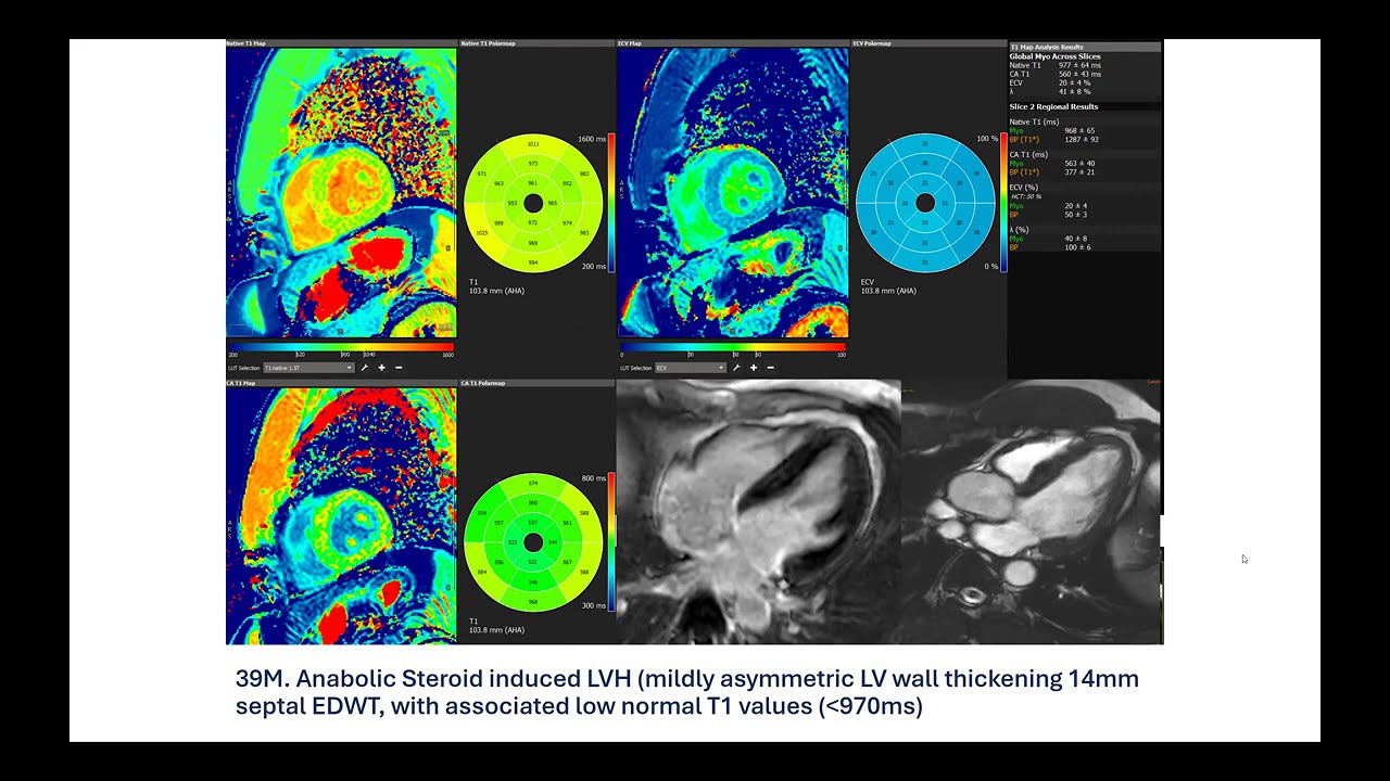Extra Cases T1 & T2 Mapping
