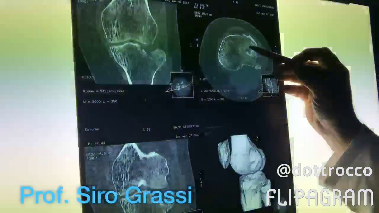 Dott. Siro Grassi intervento di frattura del piatto tibiale