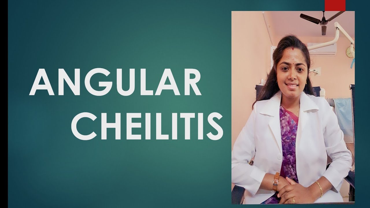 angular cheilitis,  angular stomatitis