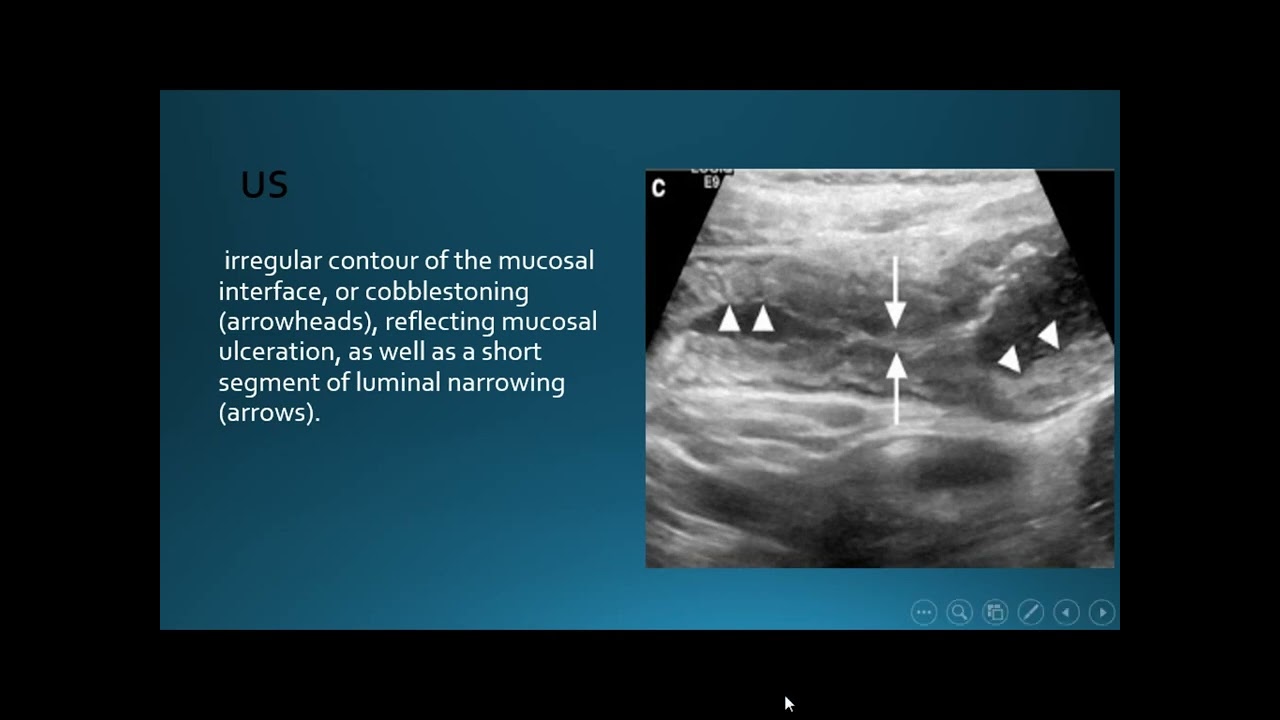 Radiological features of Crohn`s disease
