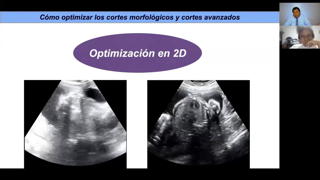 IV MasterClass | Cómo optimizar los cortes morfológicos para el diagnóstico de anomalías fetales
