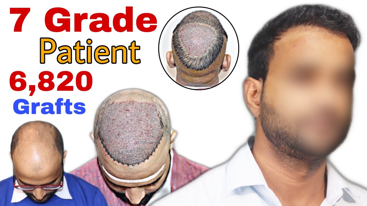 Best Hair Transplant Result 2020 || 7 Grade Patient || 6,820 Grafts || Regrow Clinic Haridwar