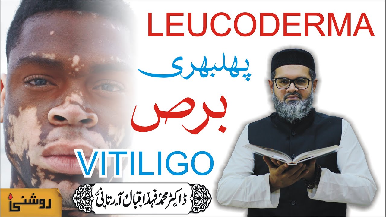 VITILIGO, LEUCODERMA AUR BARS KA ASAN ROOHANI ILAJ - Dr. FAHAD ARTANI ROSHNIWALA | Roshni Centre