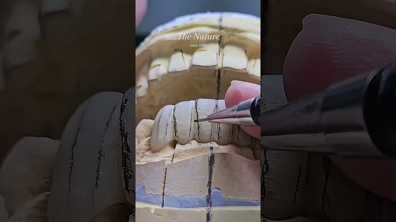하악6전치 컨쳐링 영상. NO.2 디스팅..#dental #dentaltechnician #dentist #dentalstudent