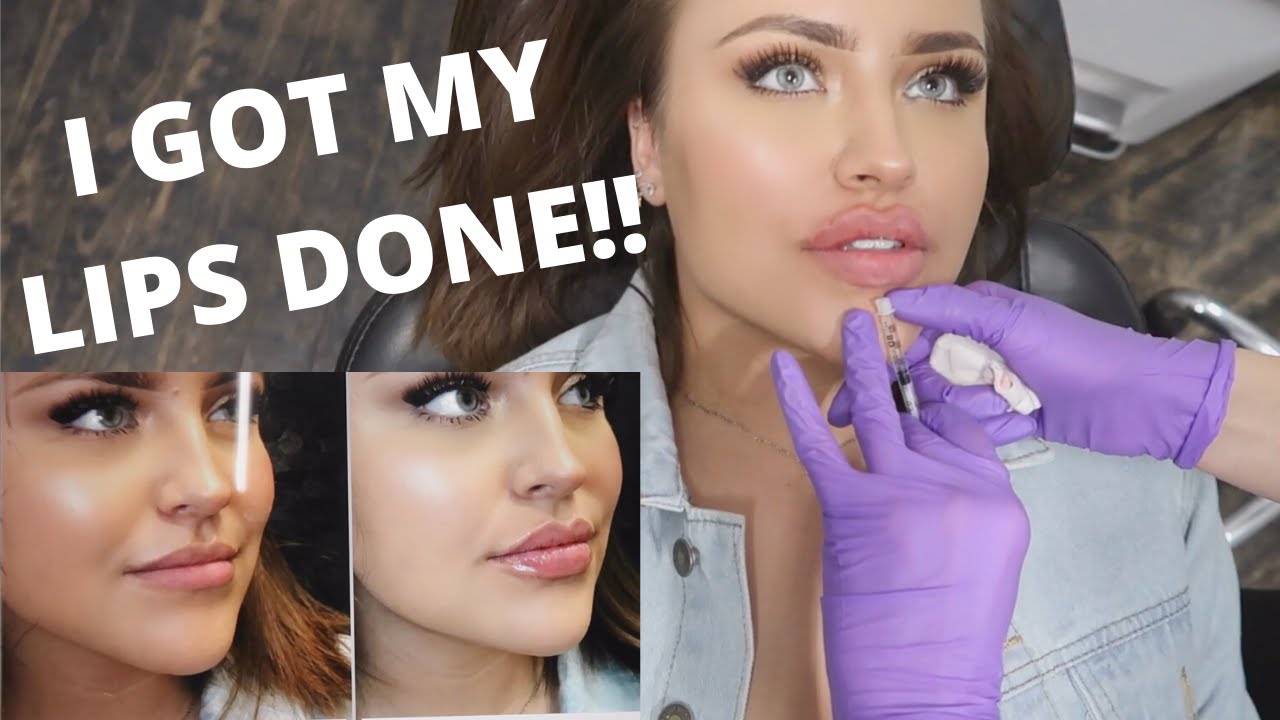 TRYING LIP FILLER FOR THE FIRST TIME! IS IT WORTH IT? VLOG