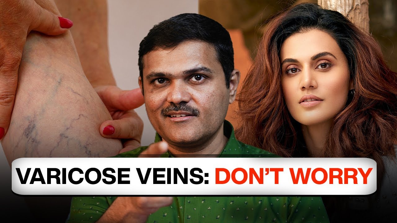 TAPSEE PANNU's Varicose Vein Recovery SECRET Revealed!