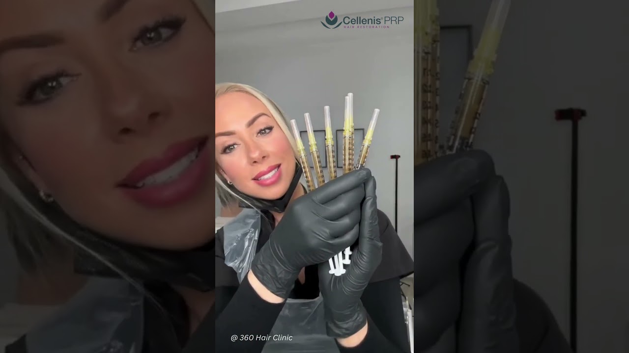 Cellenis PRP Therapy at 360 Hair Clinic