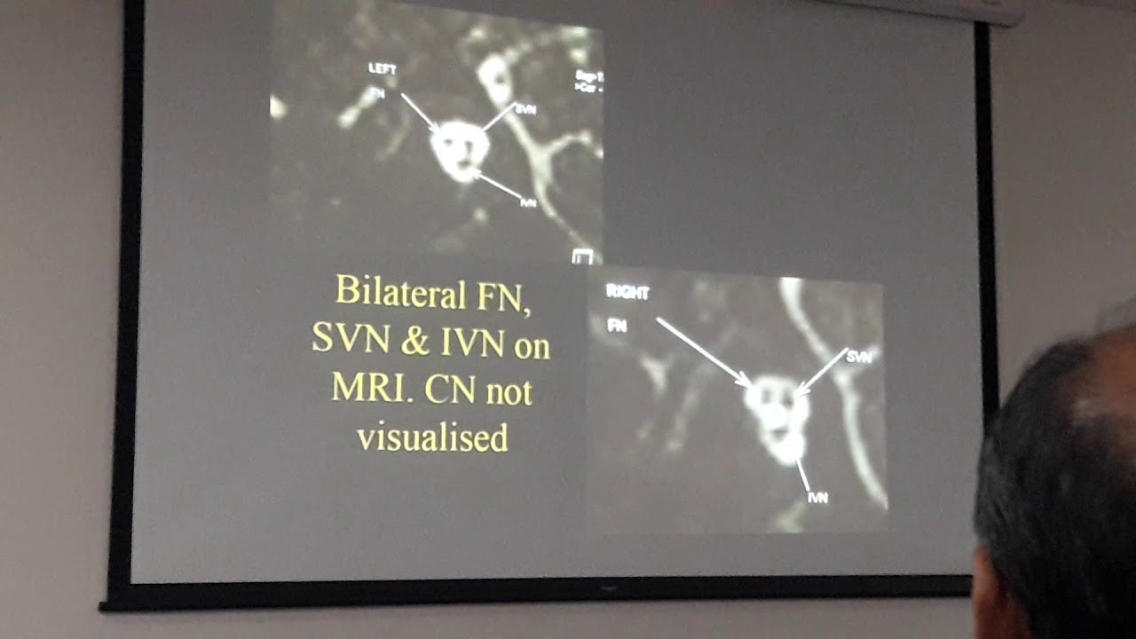 Grey zone between CI & ABI -  Dr. Mohan Kameswaran