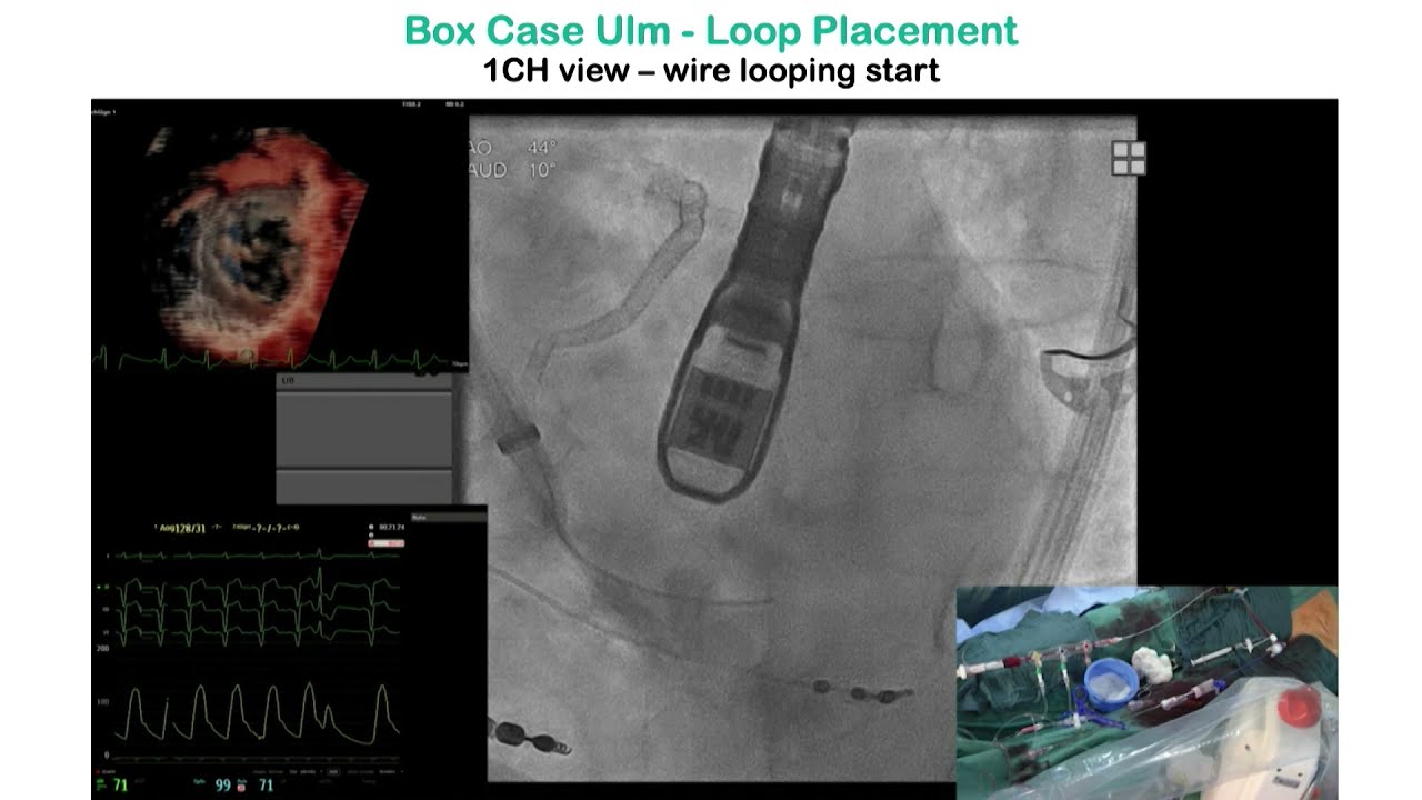 HighLife TSMVR study status and new developments - PCR London Valves 2021