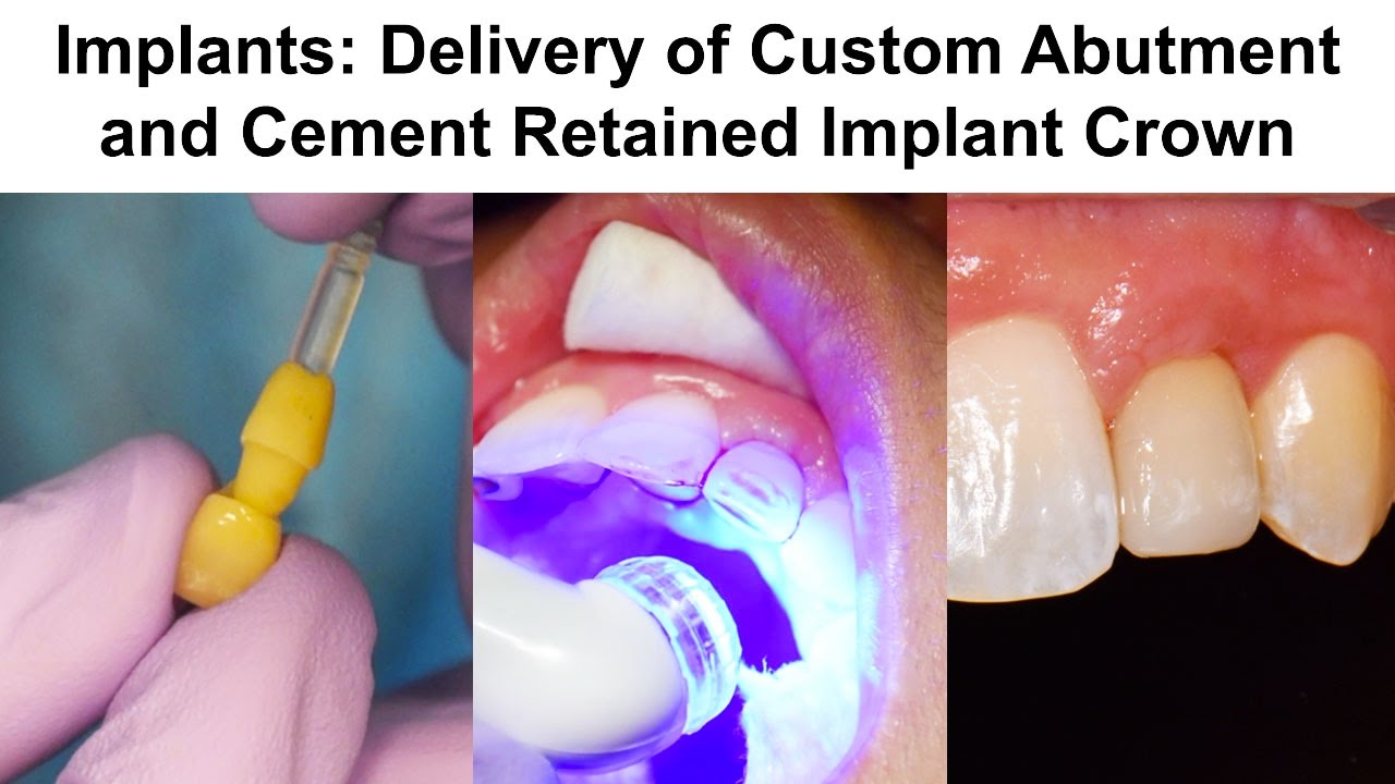 11. Implants: Delivery of Custom Abutment and Cement Retained Implant Crown