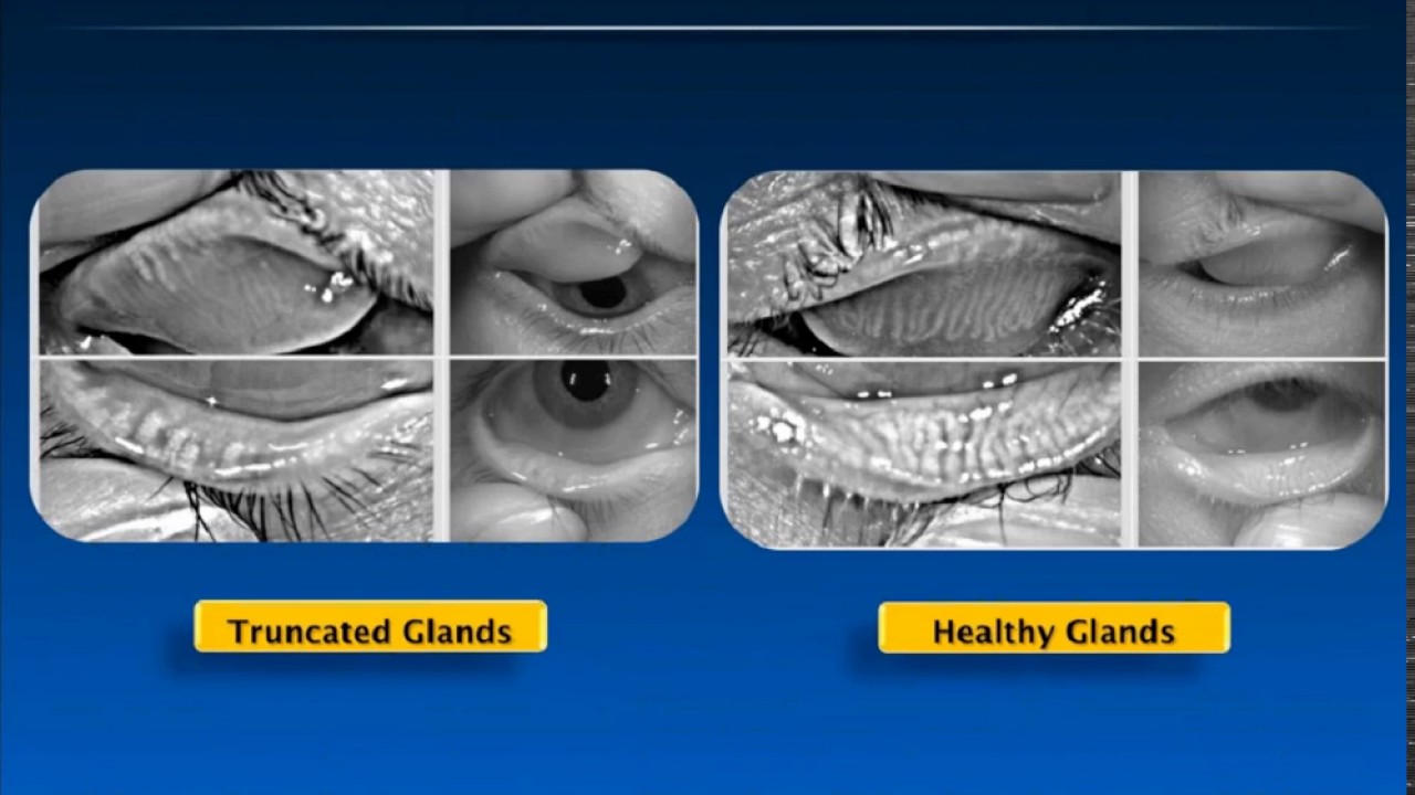 Building a Dry Eye Service - Dr. David Kading