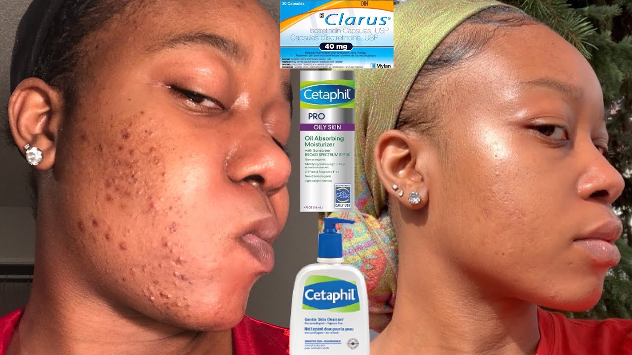 How I cleared my acne