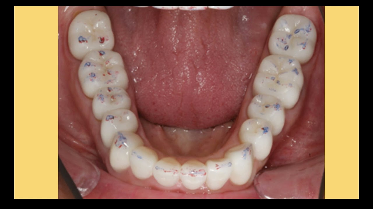 NECADE Sessions #32 - Occlusal Equilibration