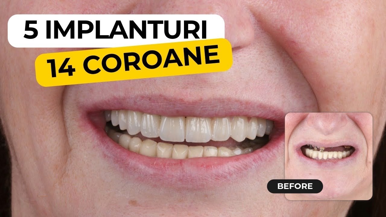 Transformare completa cu 7000 € - 5 implanturi si 14 coroane. 