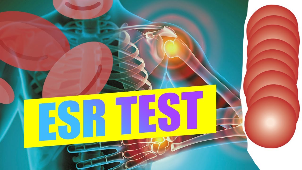 ESR blood test explained
