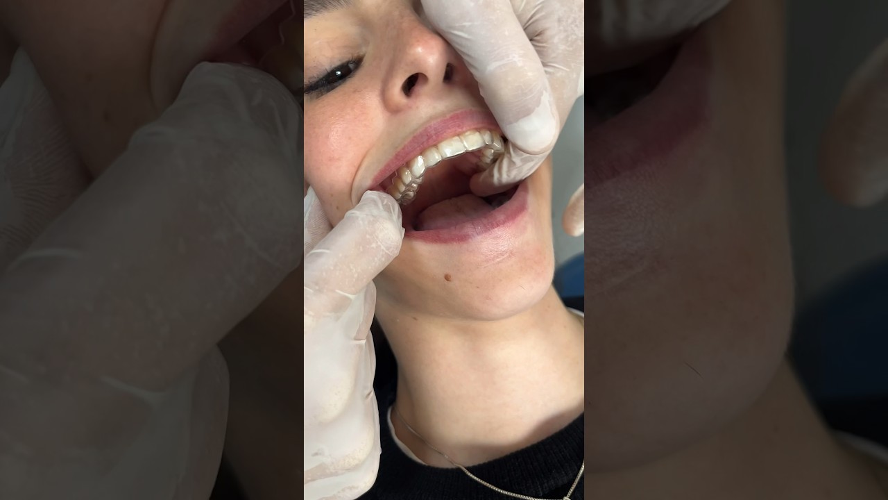 Te mostramos c&oacute;mo se ponen los alineadores KeepSmiling #alineadores #ortodonciainvisible #aligners