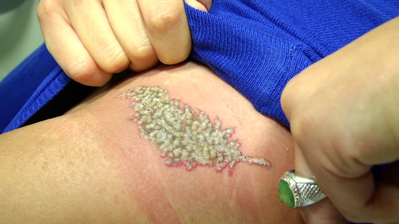 Eliminar tatuajes con Picoway
