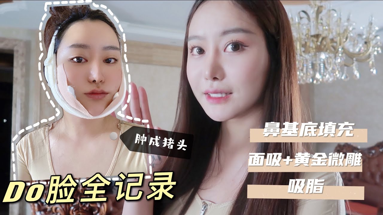 【整形记录】面部黄金微雕+上臂吸脂+鼻基底填充 | 恢复期过程 | 术后效果 | 注意事项⚠️