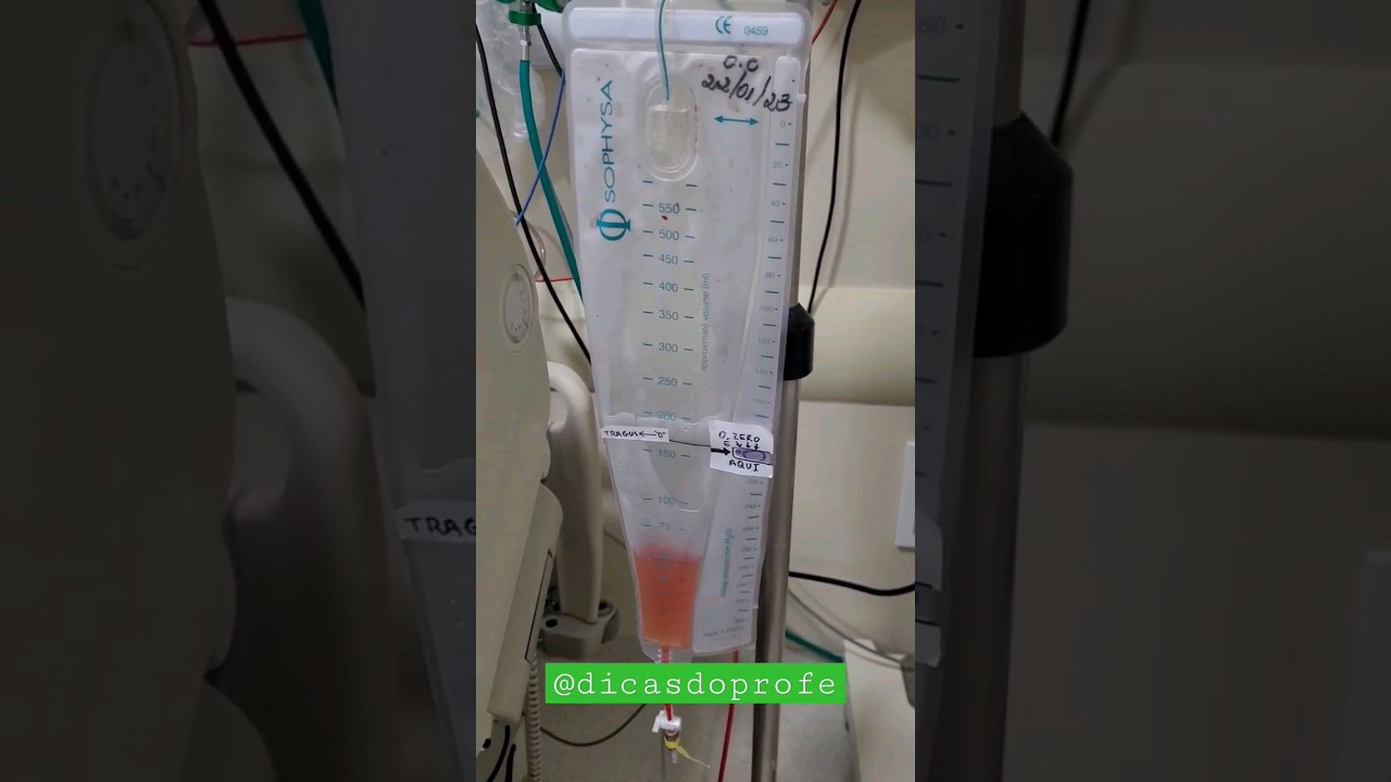 Derivação Ventricular Externa da Sophysa - modelo DVE diferentão #dve #enfermagem #sistemanervoso