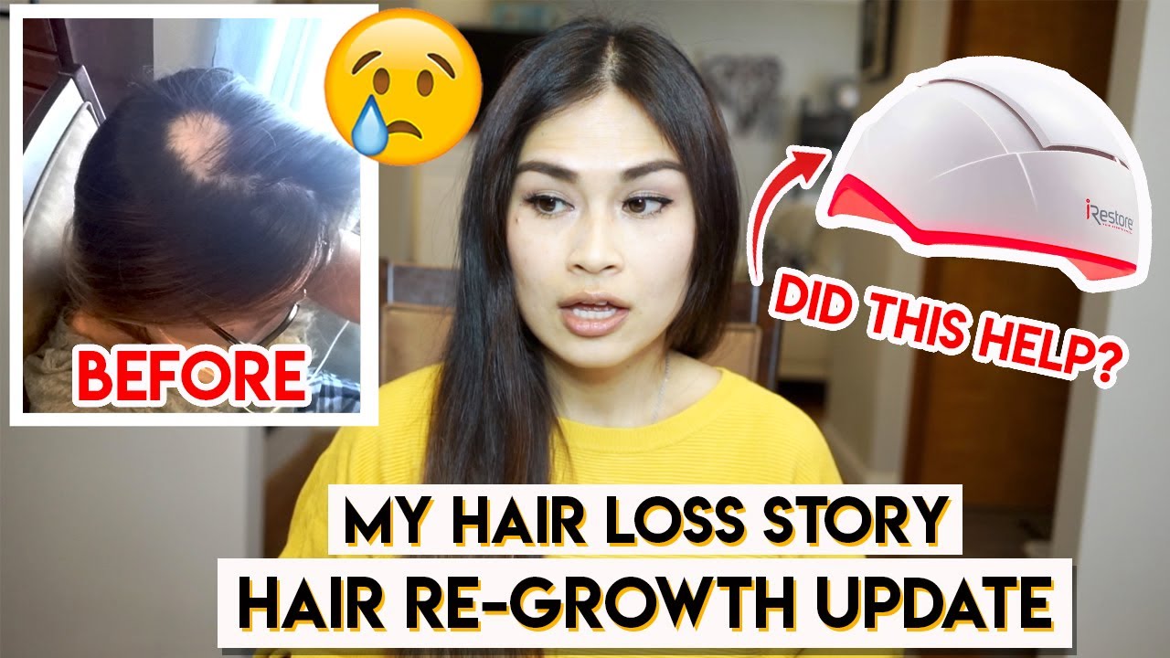 MY HAIR LOSS STORY (ALOPECIA AREATA)😢⎮iRestore LASER HAIR GROWTH SYSTEM 1-year UPDATE⎮BEFORE & AFTER